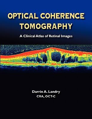 Optical Coherence Tomography a Clinical Atlas of Retinal Images