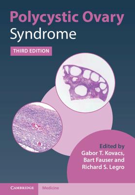 Polycystic Ovary Syndrome