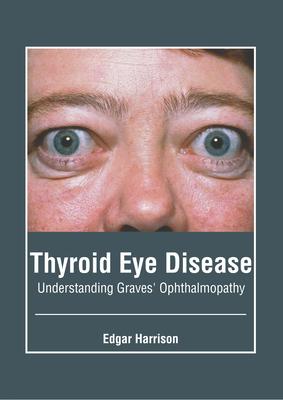 Thyroid Eye Disease: Understanding Graves' Ophthalmopathy Subscription