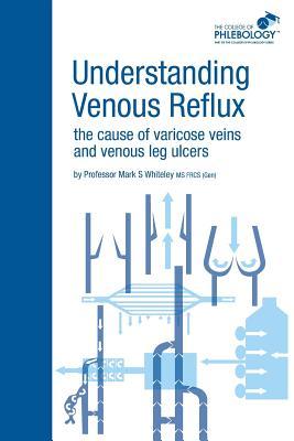 Understanding Venous Reflux the Cause of Varicose Veins and Venous Leg Ulcers: Varicose veins and venous leg ulcers