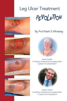 Leg Ulcer Treatment Revolution