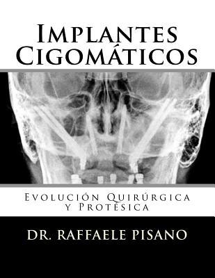 Implantes Cigomticos: Evolucin Quirrgica y Protsica