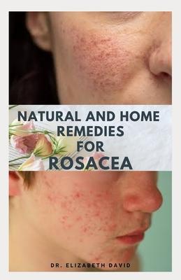 Natural and Home Remedies for Rosacea: A Self Help Guide To Completely Prevent and Treat Rosacea