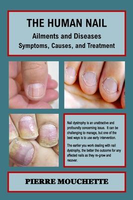 THE HUMAN NAIL - Ailments and Diseases: Symptoms, Causes, and Treatment